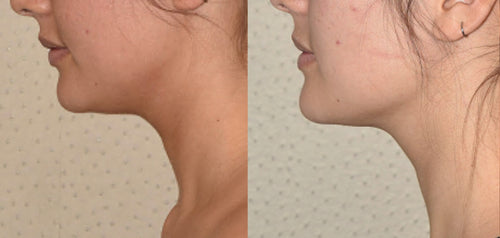 DrenaFace – Escova de Drenagem Linfática Facial